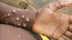Brasil soma 88 casos de Mpox em 2026 (Foto: OMS/Reprodução)